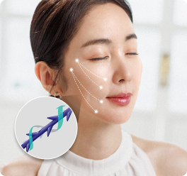 特殊线材植入与提拉