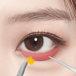 Signature Lower Blepharoplasty