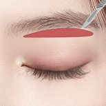 FOREVER Forehead & Sub-brow Lift