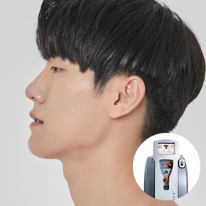남자 레이저 제모(클라리티 PRO)