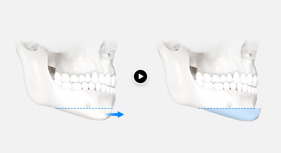 Chin Recession Surgery