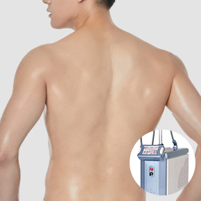 남자 레이저 제모