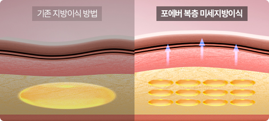 Traditional Fat Grafting vs. Multi-layer Micro Fat Grafting