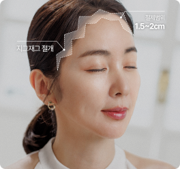 Custom Incision, Hairline Matching