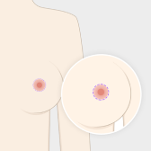 乳暈切開法