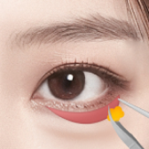 Lower Eyelid Surgery