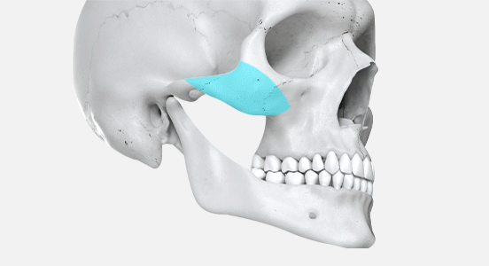 Cheek Augmentation