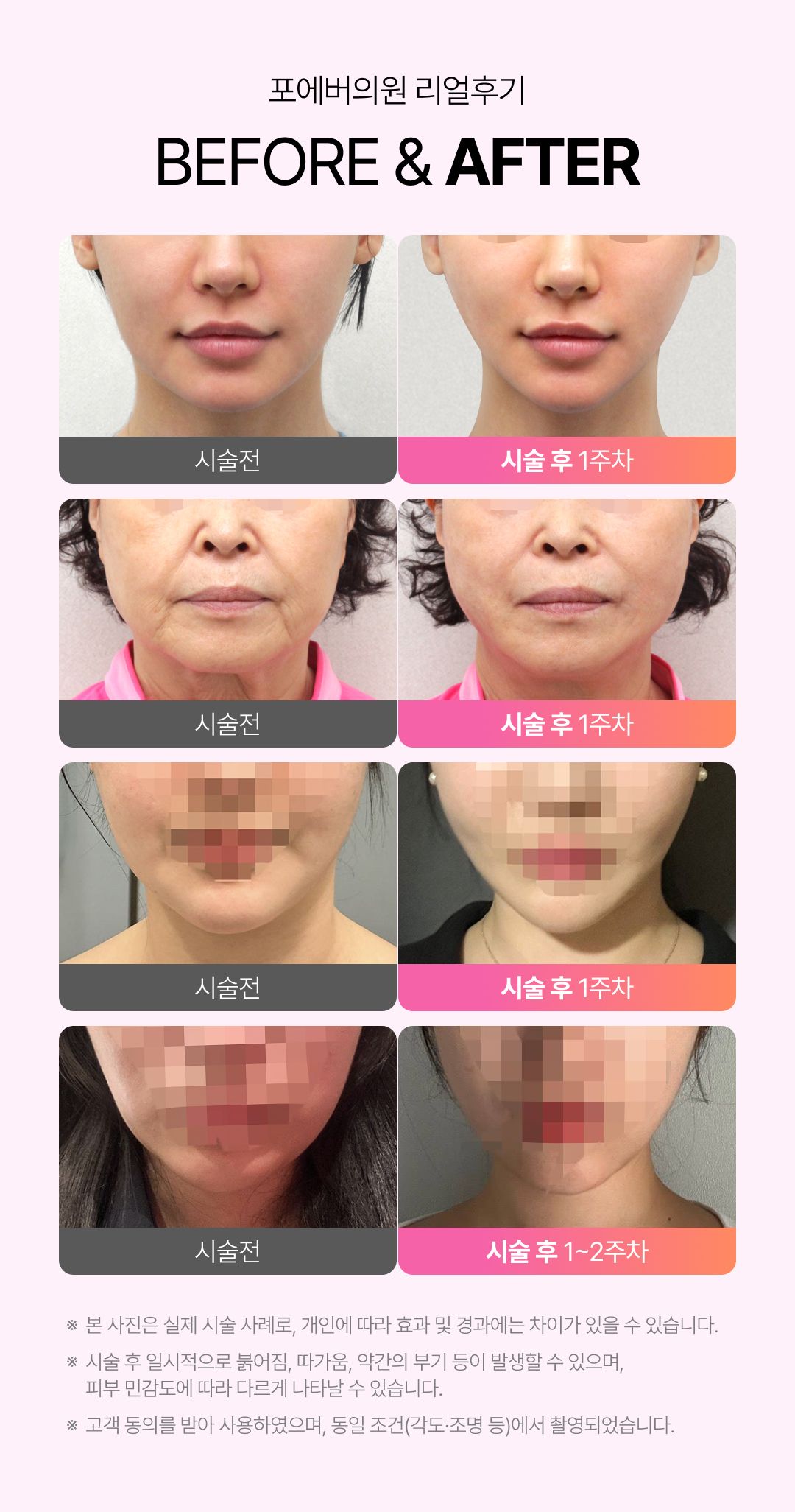 슈링크
