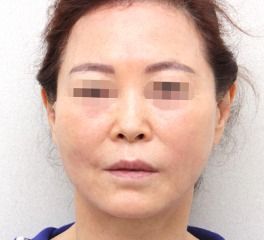 リフティング