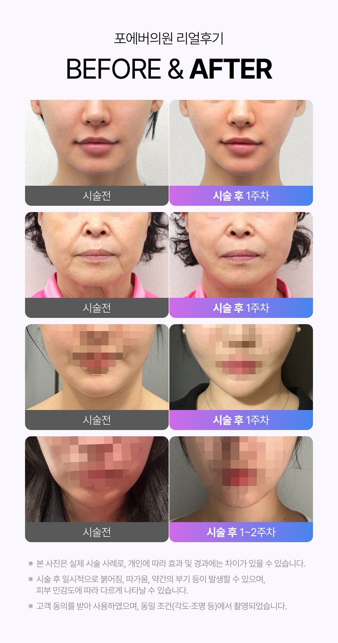 인모드 리프팅