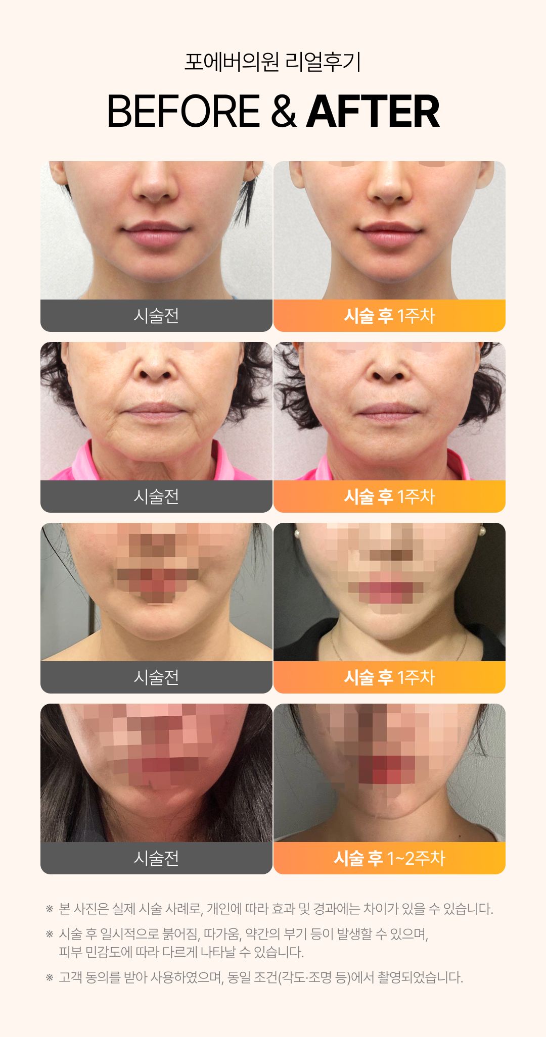 온다 리프팅