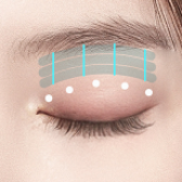 Ptosis Correction