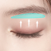 Sub-brow Lift
