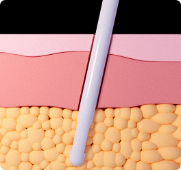 1:1オーダーメイド機器で吸引