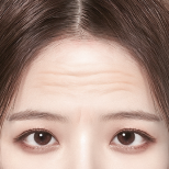 FOREVER Forehead & Sub-brow Lift