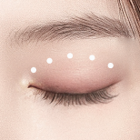 シグネチャー二重まぶた手術